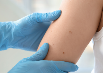 Skin cancer, skin health, moles, health check
